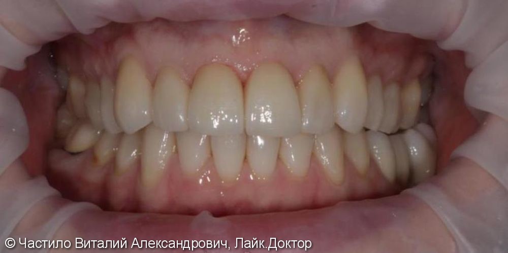 Восстановление зубов верхней челюсти при патологии прикуса. - фото №2