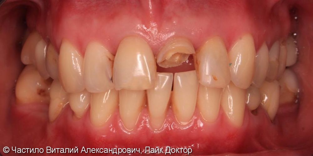Протезирование зубов верхней челюсти керамическими коронками Emax - фото №1