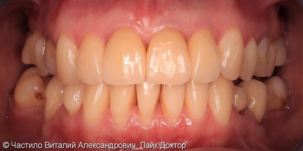 Протезирование зубов верхней челюсти керамическими коронками Emax - фото №2
