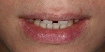 Закрытие диастемы и трем (щели) между зубами - фото №1