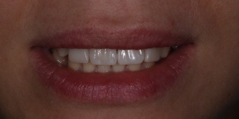 Закрытие диастемы и трем (щели) между зубами - фото №5