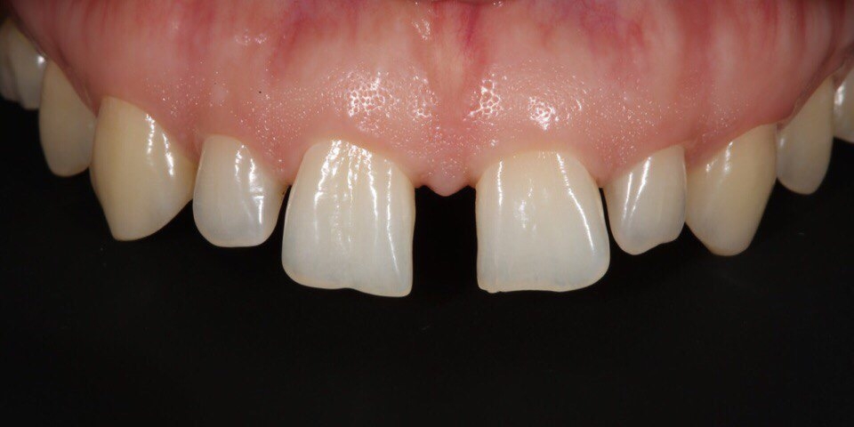 Закрытие диастемы и трем (щели) между зубами - фото №3