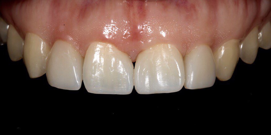 Закрытие диастемы и трем (щели) между зубами - фото №4