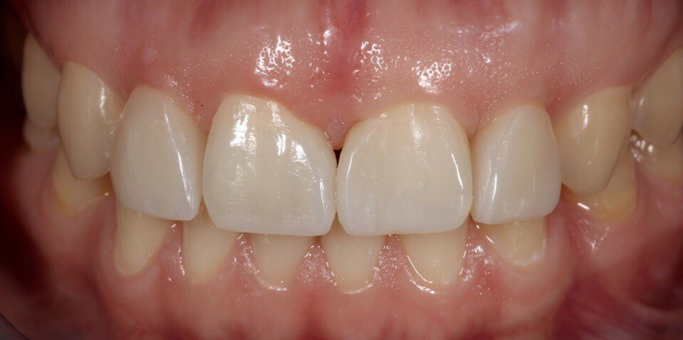Закрытие диастемы и трем (щели) между зубами - фото №2