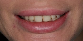 Реставрационное отбеливание зубов - фото №1