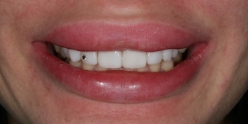 Реставрационное отбеливание зубов - фото №7