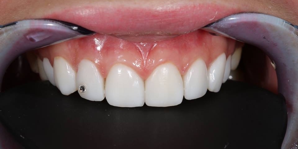 Реставрационное отбеливание зубов - фото №5