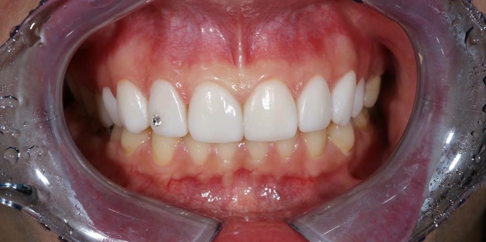 Реставрационное отбеливание зубов - фото №6