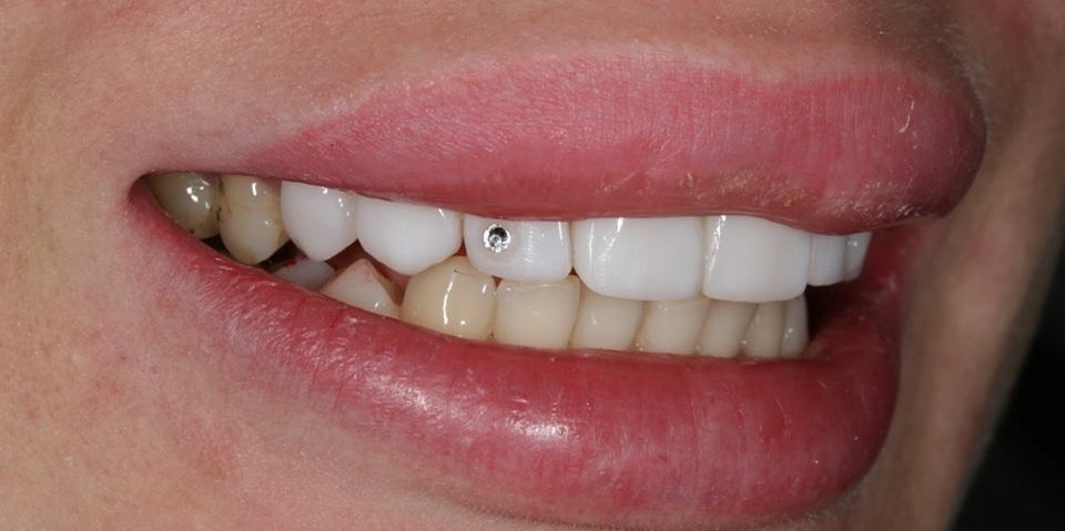 Реставрационное отбеливание зубов - фото №2