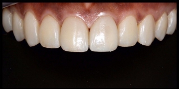 Реставрация зубов - фото №2