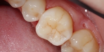 Реставрация жевательного зуба - фото №3