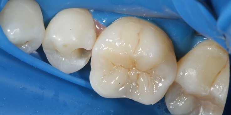 Реставрация жевательного зуба - фото №2