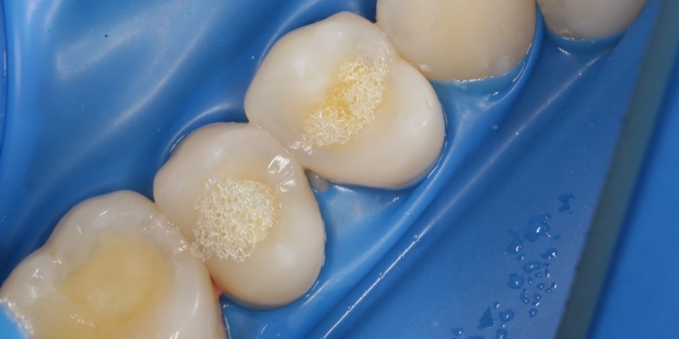 Реставрация жевательных зубов - фото №3