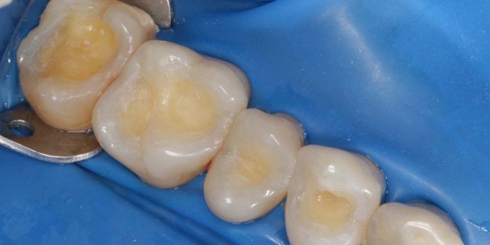 Реставрация жевательных зубов - фото №2