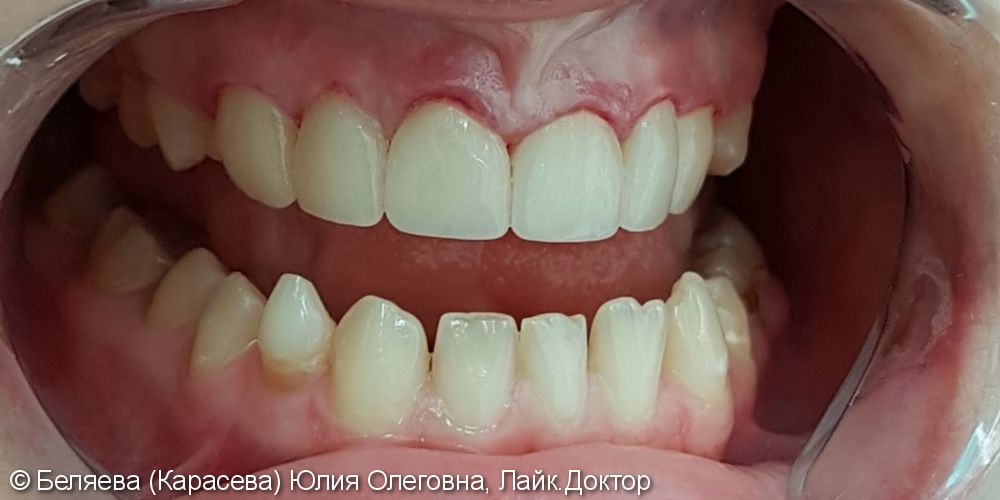 Реставрация передних зубов - фото №2