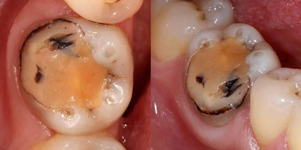 Эндодонтическое лечение и реставрация зуба - фото №1