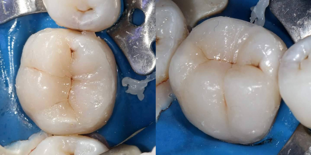 Эндодонтическое лечение и реставрация зуба - фото №5