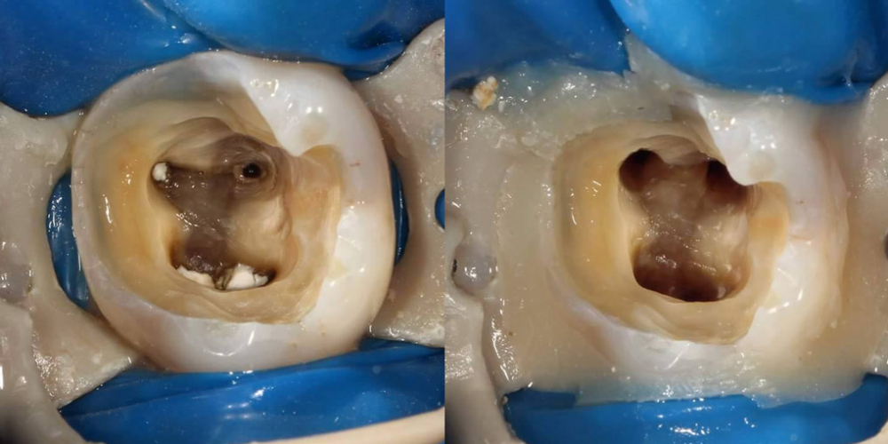 Эндодонтическое лечение и реставрация зуба - фото №3