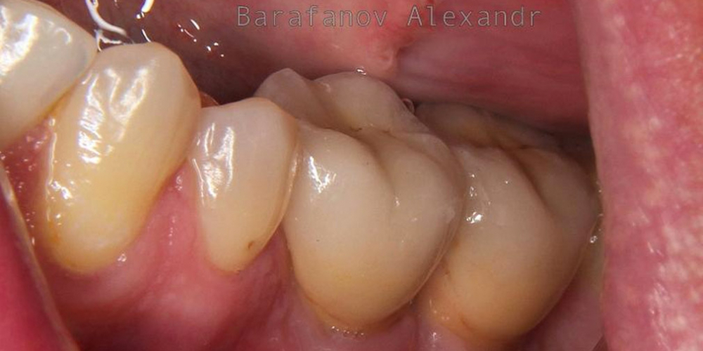 Имплантация 2 имплантатов и протезирование зубов под ключ - фото №2