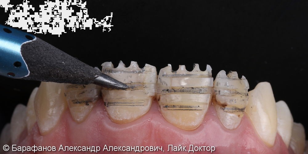 4 временные композитные коронки на передние зубы - фото №2