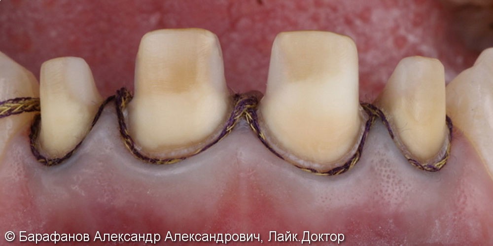 4 временные композитные коронки на передние зубы - фото №3