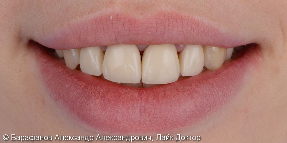 4 временные композитные коронки на передние зубы - фото №4