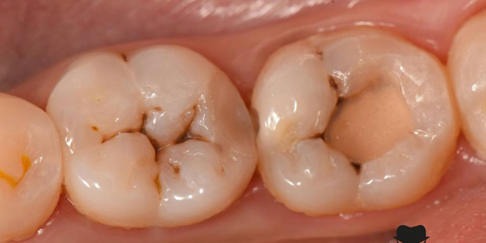 Лечение вторичного кариеса и прямая реставрация 3.6 и 3.7 зуба материалом Estelite Asteria - фото №1