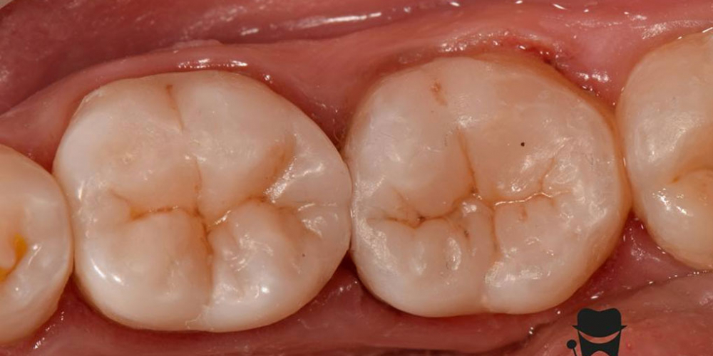 Лечение вторичного кариеса и прямая реставрация 3.6 и 3.7 зуба материалом Estelite Asteria - фото №6