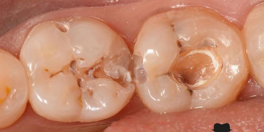 Лечение вторичного кариеса и прямая реставрация 3.6 и 3.7 зуба материалом Estelite Asteria - фото №3