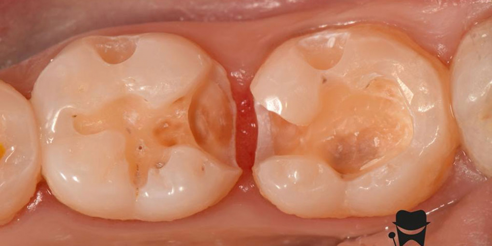 Лечение вторичного кариеса и прямая реставрация 3.6 и 3.7 зуба материалом Estelite Asteria - фото №4