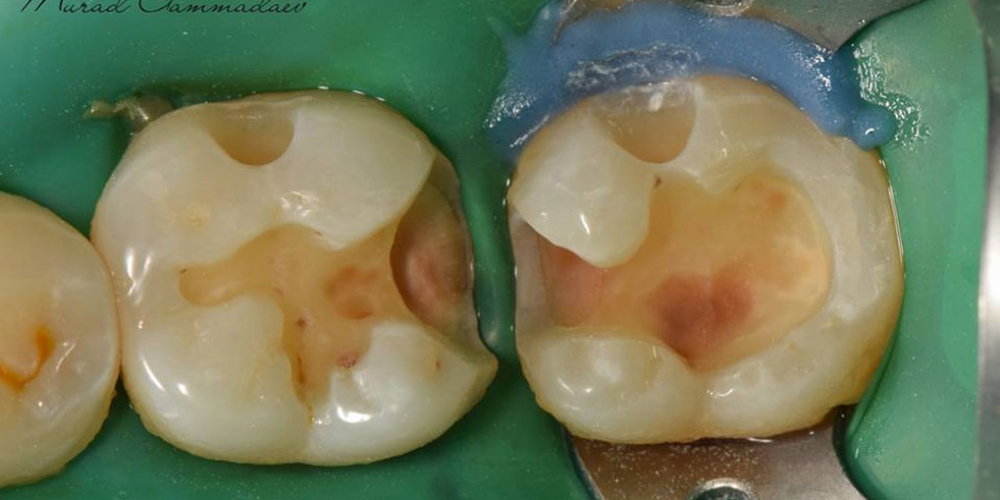 Лечение вторичного кариеса и прямая реставрация 3.6 и 3.7 зуба материалом Estelite Asteria - фото №5