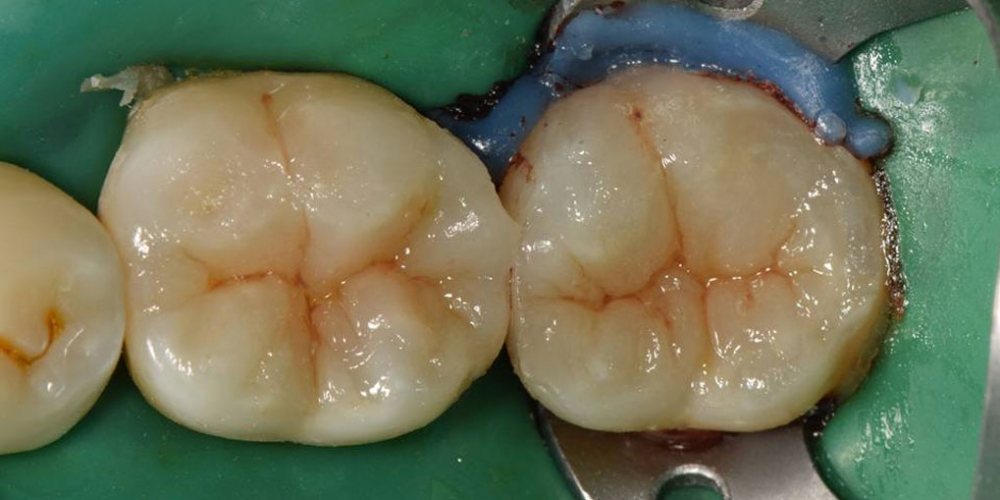 Лечение вторичного кариеса и прямая реставрация 3.6 и 3.7 зуба материалом Estelite Asteria - фото №2