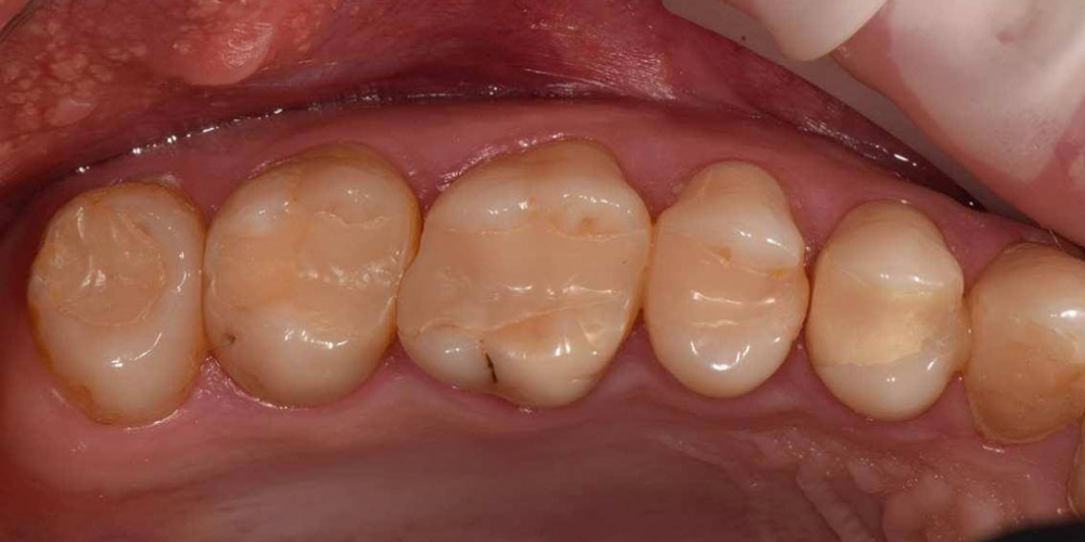 Реабилитация жевательной группы зубов - фото №1