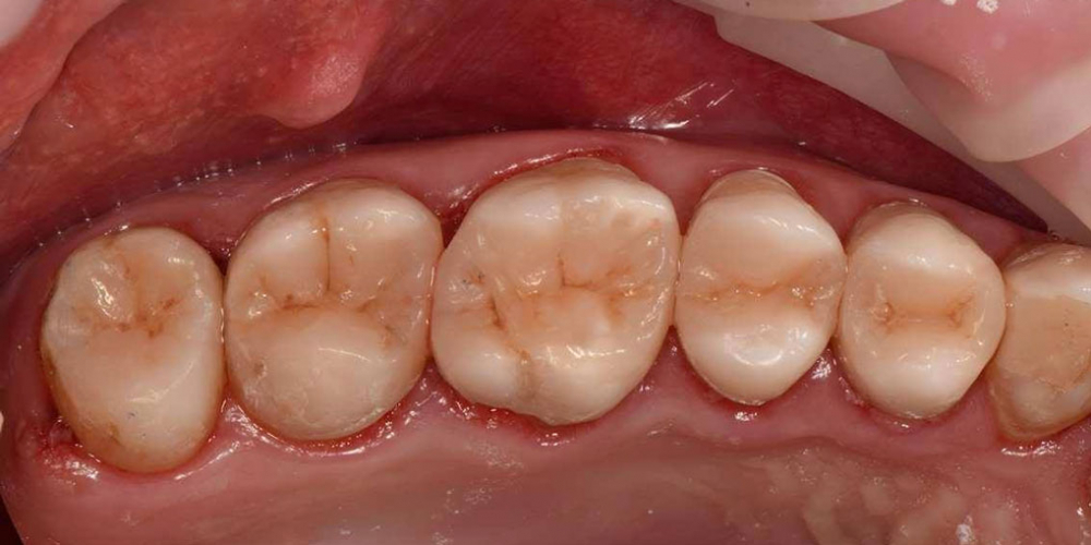 Реабилитация жевательной группы зубов - фото №11