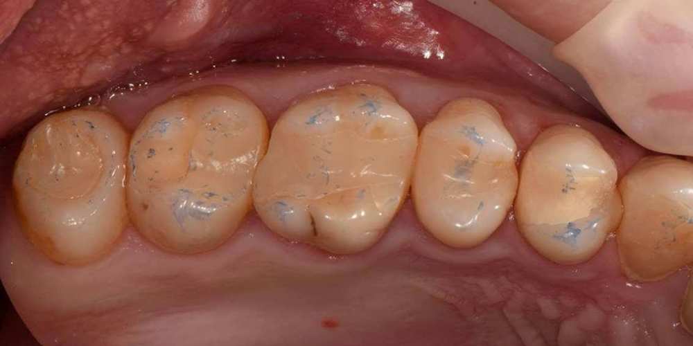 Реабилитация жевательной группы зубов - фото №3