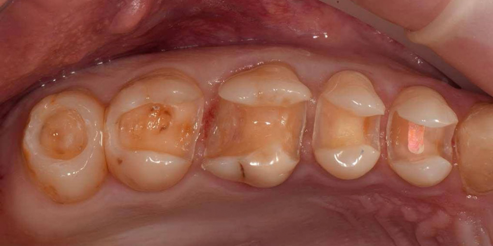 Реабилитация жевательной группы зубов - фото №4
