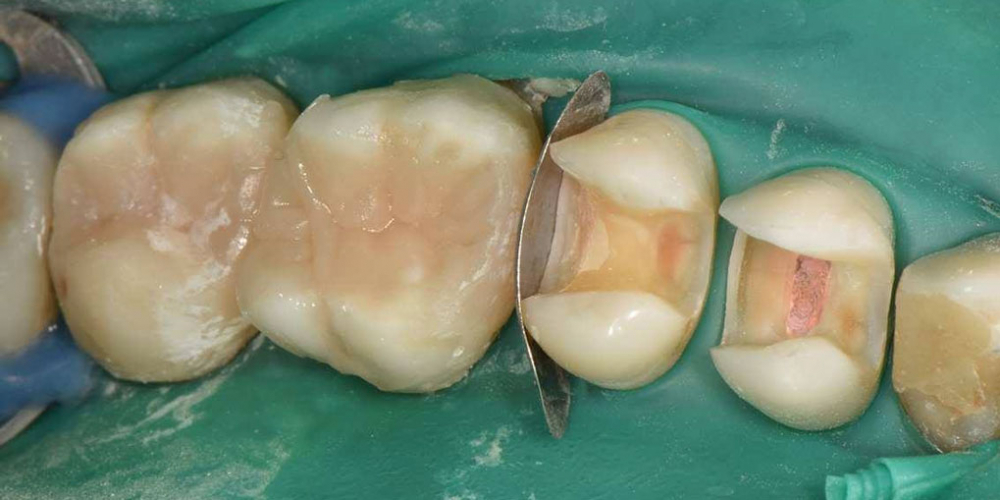 Реабилитация жевательной группы зубов - фото №8