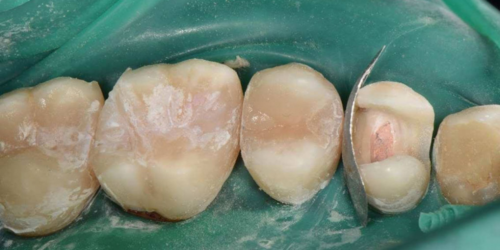 Реабилитация жевательной группы зубов - фото №9