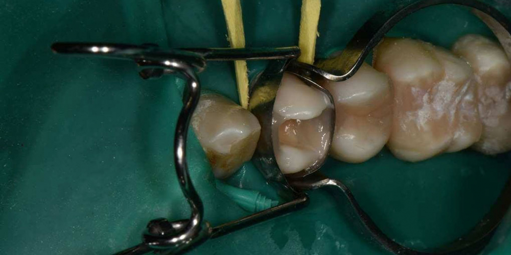 Реабилитация жевательной группы зубов - фото №10