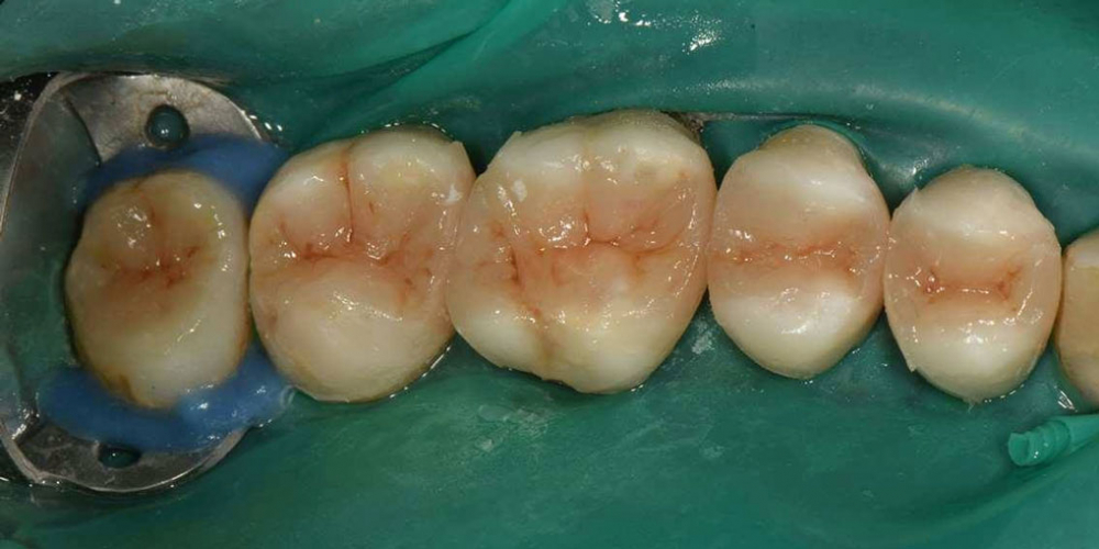 Реабилитация жевательной группы зубов - фото №2