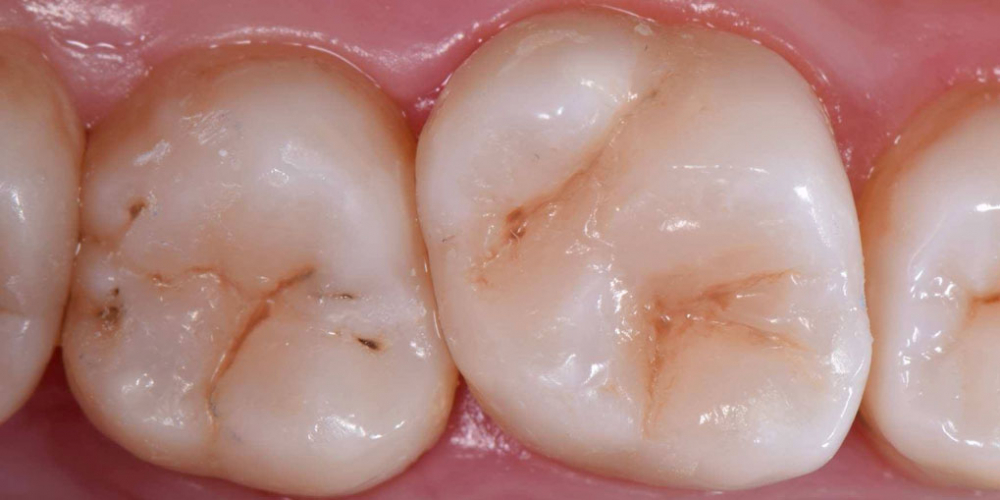 Лечение кариеса 1.6 и 1.7 зубов - фото №4