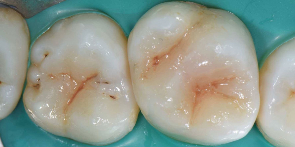 Лечение кариеса 1.6 и 1.7 зубов - фото №2