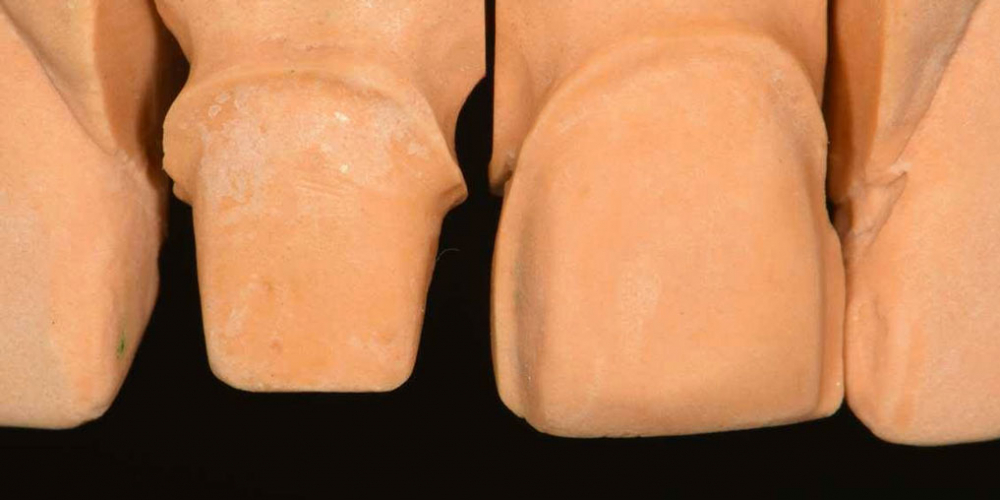 Эстетическая реабилитация центральных резцов верхней челюсти цельнокерамическими реставрациями e max - фото №4