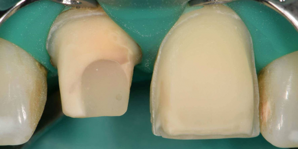 Эстетическая реабилитация центральных резцов верхней челюсти цельнокерамическими реставрациями e max - фото №8