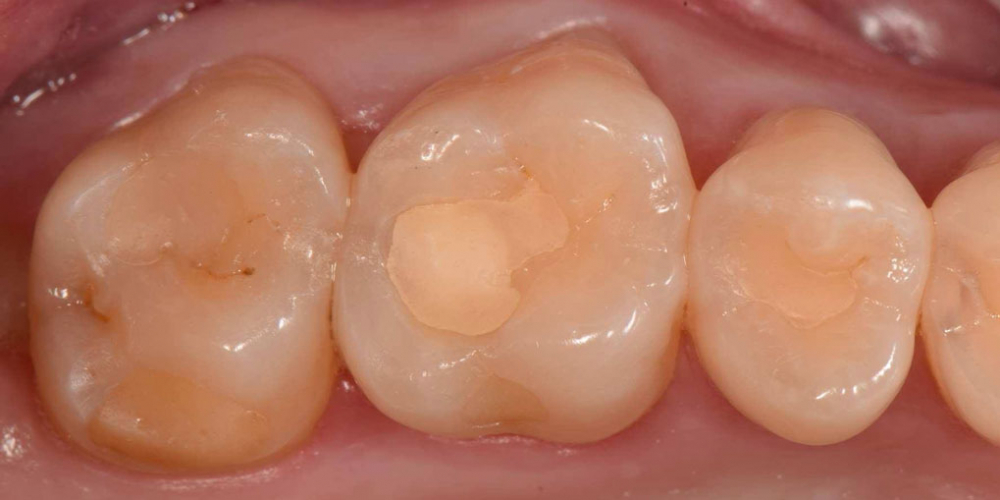 Реставрация трех жевательных зубов - фото №1