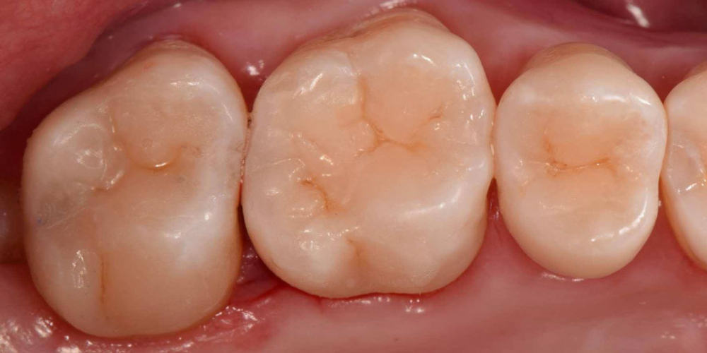 Реставрация трех жевательных зубов - фото №5