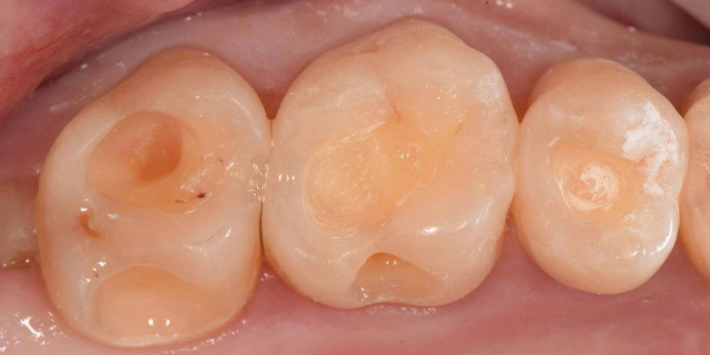 Реставрация трех жевательных зубов - фото №3