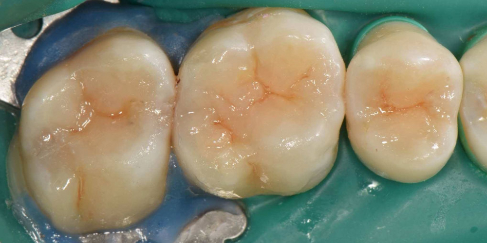 Реставрация трех жевательных зубов - фото №2
