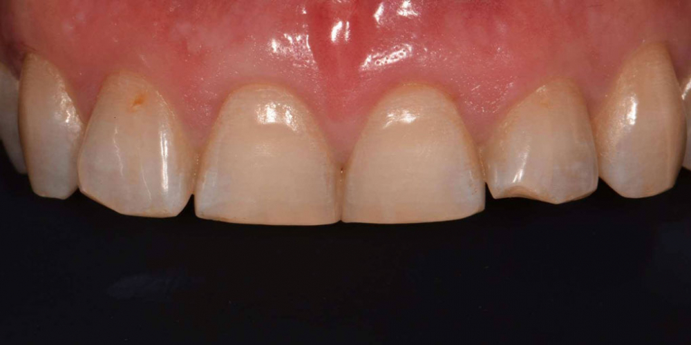 Эстетическая реабилитация фронтальной группы зубов методом прямой композитной реставрации - фото №1