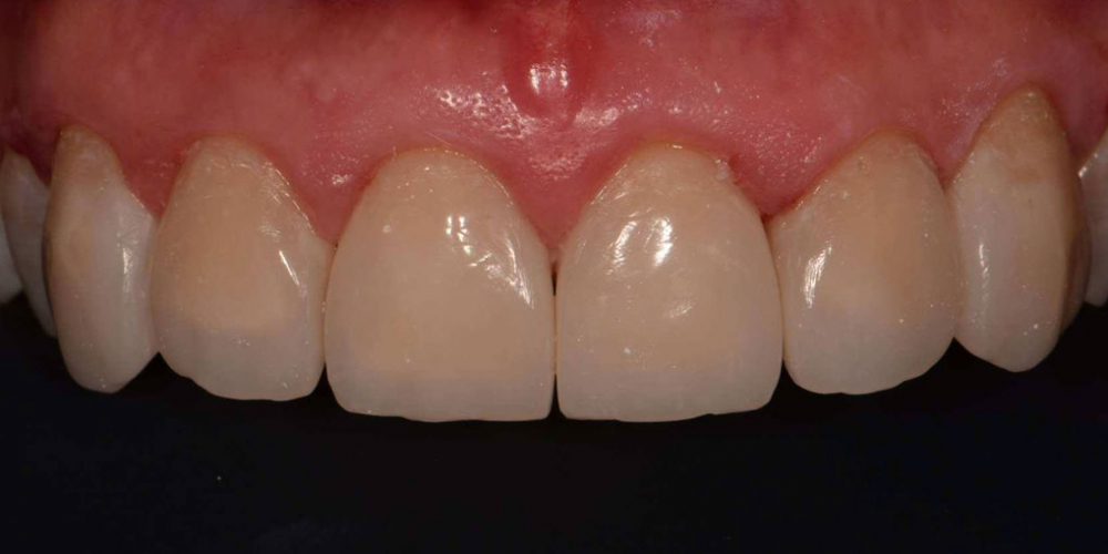 Эстетическая реабилитация фронтальной группы зубов методом прямой композитной реставрации - фото №10